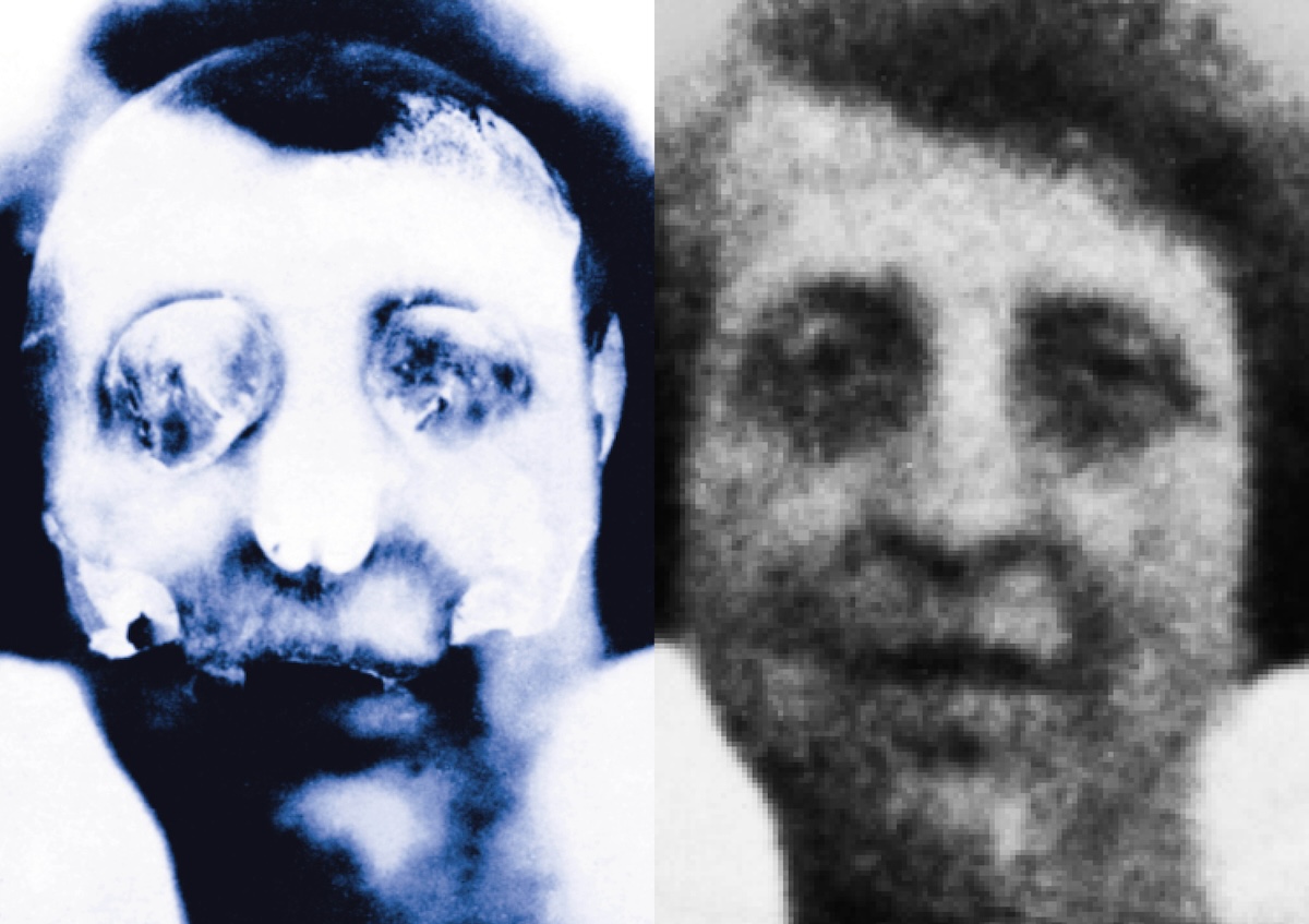 The superimposed image of Rachel Dobkin produced by Mary Newman, Guy’s Hospital, 1942. TopFoto/Mirrorpix.