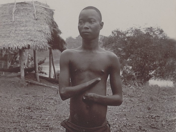 A Congolese boy whose hands were cut off for not collecting enough rubber. Museum of Ethnography. Public Domain.